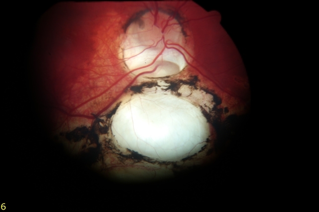 Clinical photographs of human ocular colobomata. (a ) typical iris Coloboma - Retina Image Bank