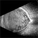 Calcification of the Retina Calcification of the Retina