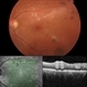 Benign Lobular Inner Nuclear Layer Proliferations (BLIP) Benign Lobular Inner Nuclear Layer Proliferations (BLIP)