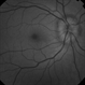 Optic Nerve Edema Optic Nerve Edema