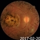 Macular Coloboma and Pigmentary Retinopathy Macular Coloboma and Pigmentary Retinopathy