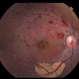 Optic Nerve Head Avulsion Optic Nerve Head Avulsion