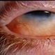 Linear Nevus Sebaceous Syndrome Linear Nevus Sebaceous Syndrome
