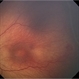 Stage 2 ROP