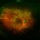 Optic Atrophy and Attenuated Retinal Vessels Following Endophthalmitis Optic Atrophy and Attenuated Retinal Vessels Following Endophthalmitis