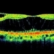 Bilateral Myopic Foveoschisis