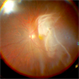 Intra-operative still of  Rhegmatogenous Retinal Detachment Intra-operative still of  Rhegmatogenous Retinal Detachment