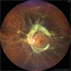 Annular Diabetic Tractional Retinal Detachment Annular Diabetic Tractional Retinal Detachment