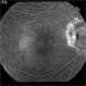 Optic Nerve Pit Related Serous Retinal Detachment