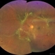 Traction Retinal Detachment Traction Retinal Detachment