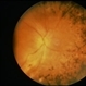 Necrotizing Retinitis Necrotizing Retinitis