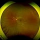 Severe Proliferative Diabetic Retinopathy Severe Proliferative Diabetic Retinopathy