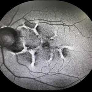 RPE Tear After Anti-VEGF Injection - Retina Image Bank