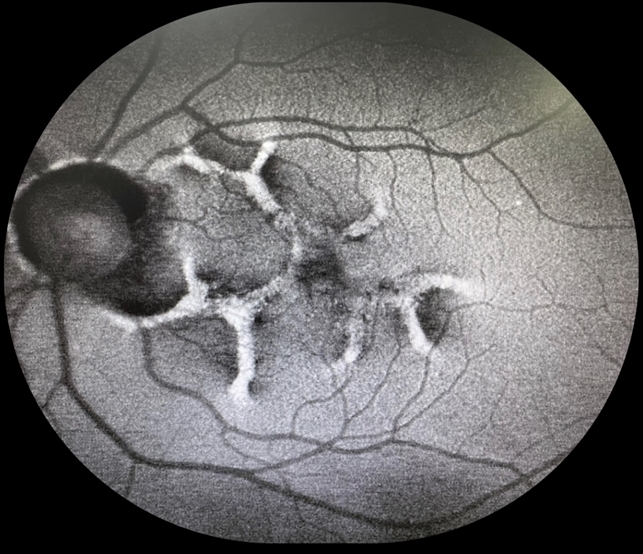 OS FAF Reticular Pattern Dystrophy - Retina Image Bank