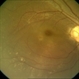 Disc Pit With Maculopathy Disc Pit With Maculopathy
