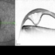 Acquired Optic Pit Maculopathy Acquired Optic Pit Maculopathy