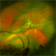 Dislocated Iol With Hypotony Maculopathy and Hemorrhagic Choroidal Dislocated Iol With Hypotony Maculopathy and Hemorrhagic Choroidal