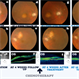 Rare Bilateral Choroidal Metastasis from Occult Primary Lung Cancer Rare Bilateral Choroidal Metastasis from Occult Primary Lung Cancer