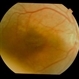Posterior Microphthalmos