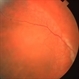 Bullous Retinoschisis Bullous Retinoschisis
