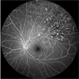Branch Retinal Vein Occlusion Branch Retinal Vein Occlusion