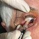 Intravitreal Injection Intravitreal Injection