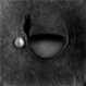 SUB-HYALOID HEMORRHAGE SUB-HYALOID HEMORRHAGE