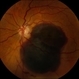 Submacular Hemorrhage Submacular Hemorrhage