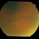 Bilateral Senile Retinoschisis