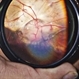 Fundal Coloboma Fundal Coloboma