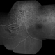 Hemi Vein Occlusion, Fluorescein Angiogram, Montage