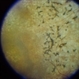 Retinitis Pigmentosa (RP)