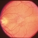 Macular Pucker After Retinal Detachment Macular Pucker After Retinal Detachment
