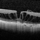 Myopic Macular Schisis with Lamellar Macular Hole Myopic Macular Schisis with Lamellar Macular Hole