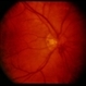 Optic Disc Hemorrhage