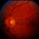 Talc Retinopathy