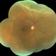 Macula sparing Superior  Rhegmatogenous retinal detachment Macula sparing Superior  Rhegmatogenous retinal detachment