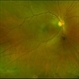 Proliferative Sickle Cell Retinopathy, Color OD