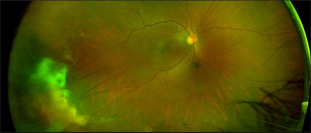 Proliferative Sickle Cell Retinopathy, Color OD - Retina ...