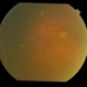 Retinal Fold Near Retinal Break in Rhegmatogenous Retinal Detachment