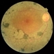 Retinitis Pigmentosa