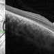 Focal Choroidal Excavation in a Case of Choroidal Rupture Focal Choroidal Excavation in a Case of Choroidal Rupture