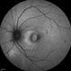 Traumatic Macular Hole and Choroidal Ruptures Traumatic Macular Hole and Choroidal Ruptures