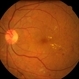 Maculopathy and IRMA Left Retina