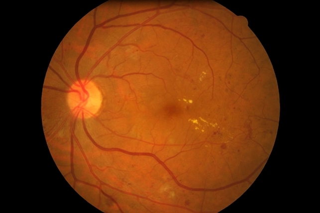 Maculopathy And Irma Left Retina Retina Image Bank