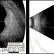 USG in Case of Choroidal Hemangioma With Associated Exudative RD USG in Case of Choroidal Hemangioma With Associated Exudative RD