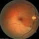 Platelet Fibrin Emboli Fisher Platelet Fibrin Emboli Fisher