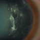 Vitreous Amyloidosis Slit Lamp Photo