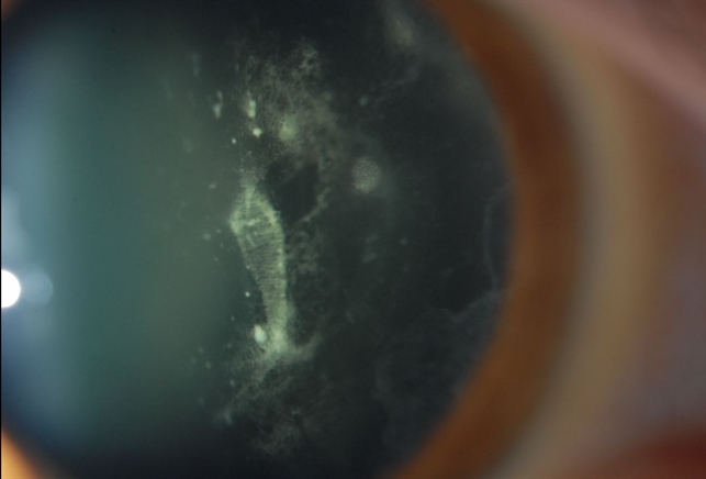 Vitreous Amyloidosis Slit Lamp Photo - Retina Image Bank