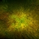 Leber´s Congenital Amaurosis Leber´s Congenital Amaurosis